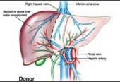 77_ParaS_Live-Donor-Liver